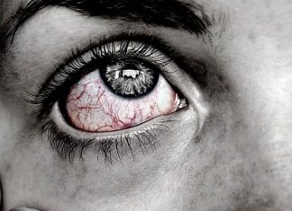 Jenis-Jenis Infeksi Mata Dan Cara Mengobatinya